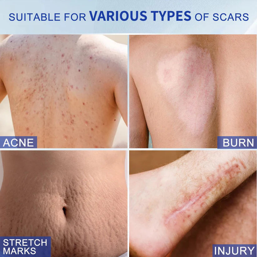 Scar Removal Gel for Old and New Scars