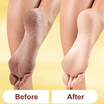 Khojlooo SmoothFeet Pro™ – Cracked Heel & Dead Skin Remover