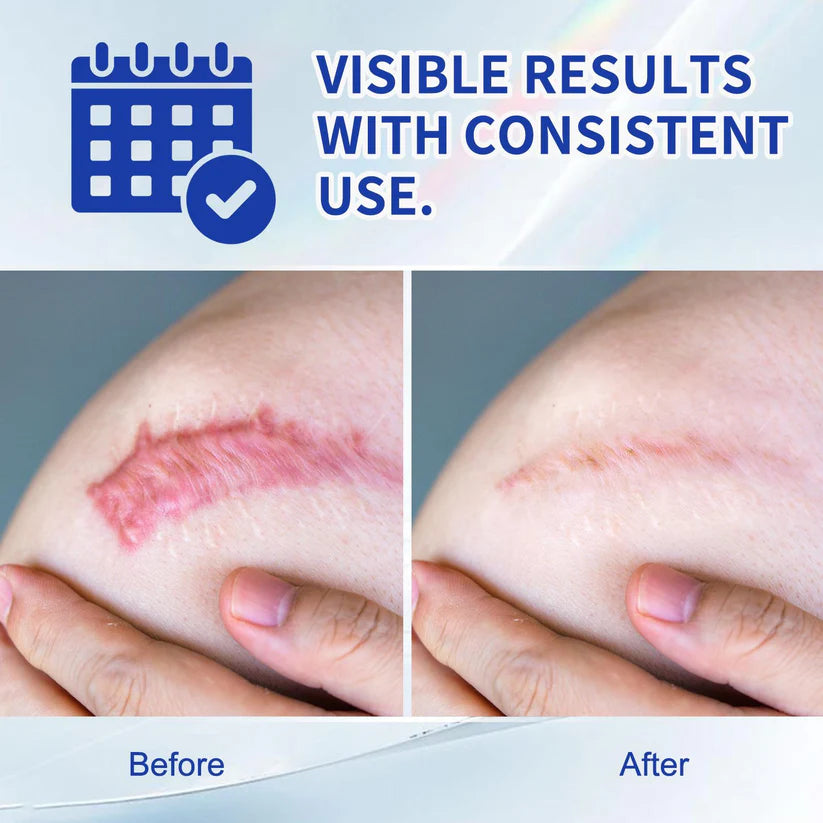 Scar Removal Gel for Old and New Scars
